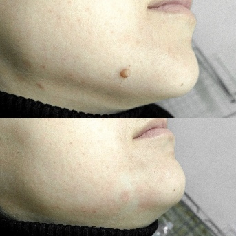 Before and after the application of Skincell Pro
