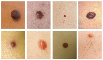 The most common spots on the skin is nevus and papilloma (warts)