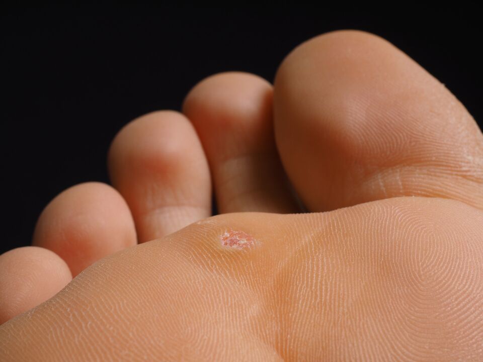 What does a plantar wart look like 