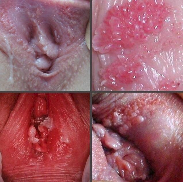 Papillomas approach the vagina