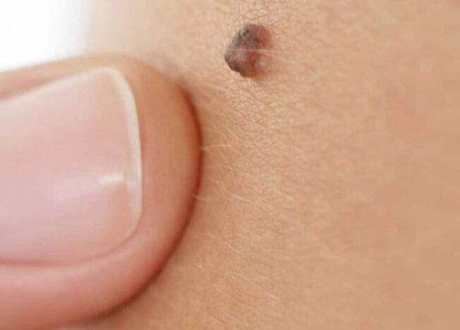 Why does a papilloma appear on the body 