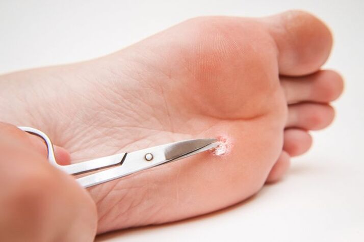 Cut a wart on the feet