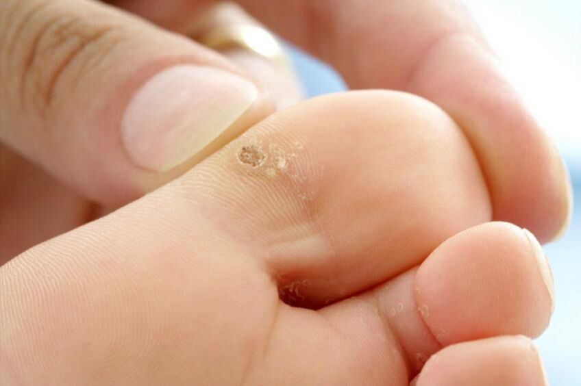 Warts on the toe