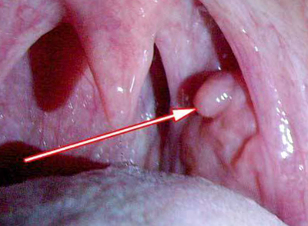 Papilloma in the laryngeal cavity