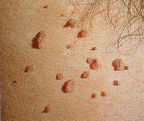 Human papillomavirus on the skin