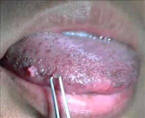 Human papillomavirus on the tongue