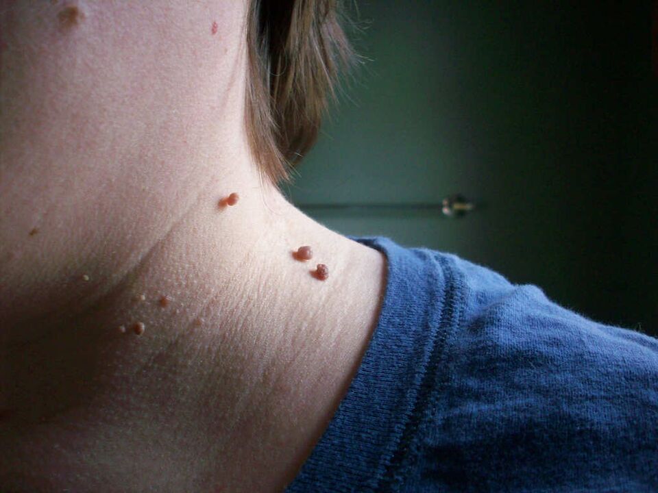 How to treat papillomas on the neck