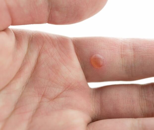 A wart on a finger