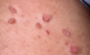 Causes of papillomas on the body