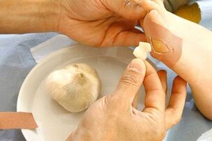 Treatment of papilloma with garlic compress